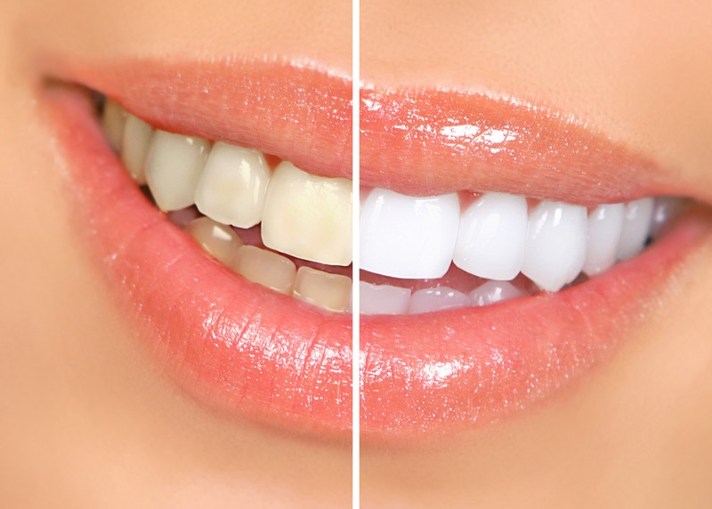 Teeth Whitening  Portland, OR 