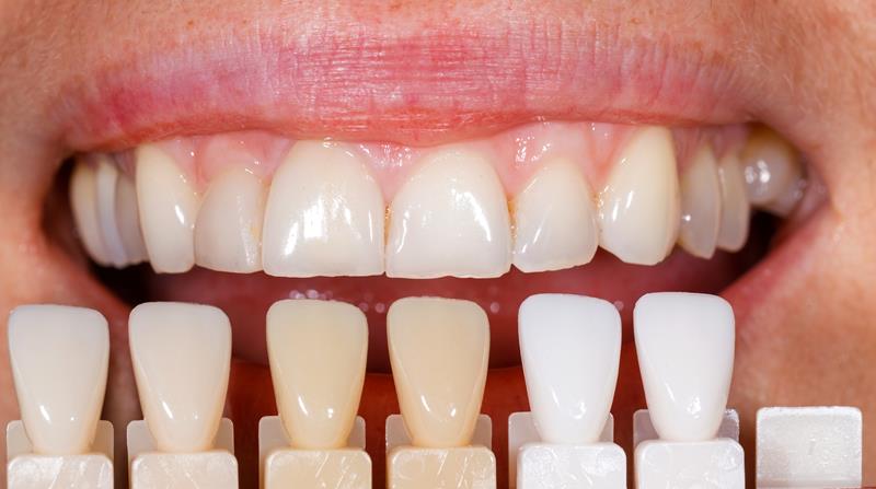 Veneers  Portland, OR 