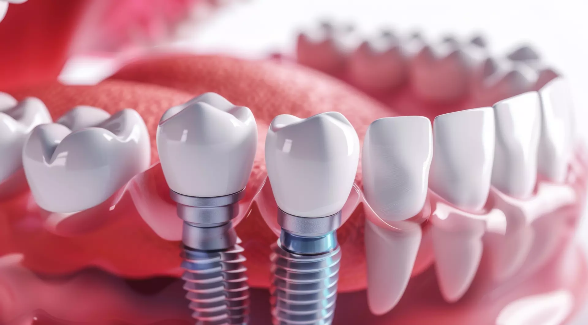 After Dental Implant Surgery