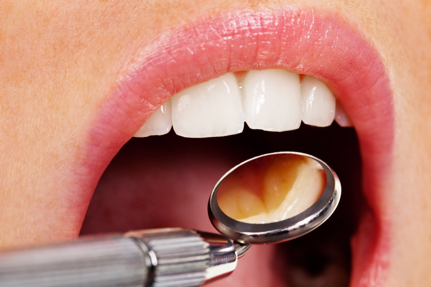 Periodontal Disease